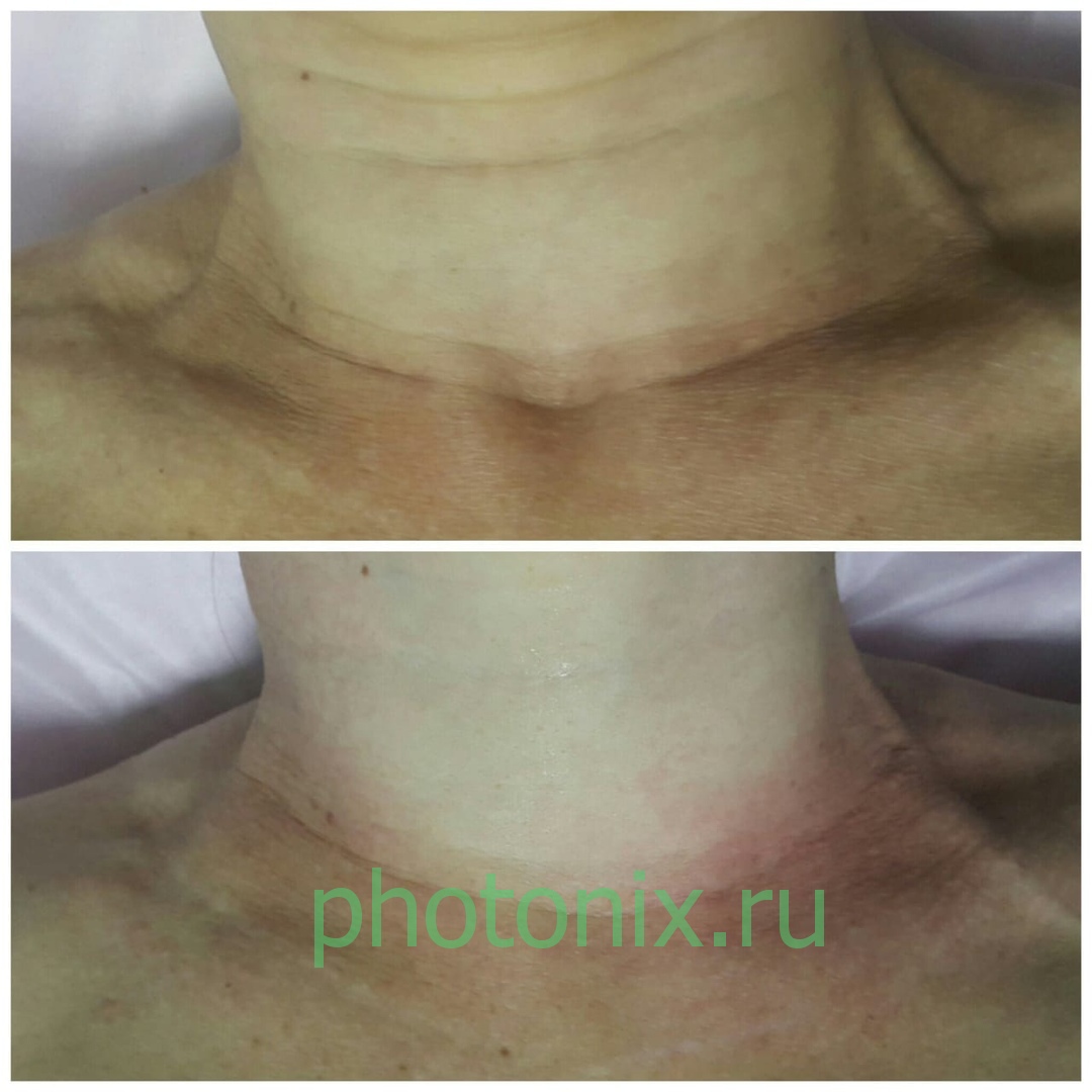 Ультразвуковой аппарат HIFU anti aging FU4.5-9S
