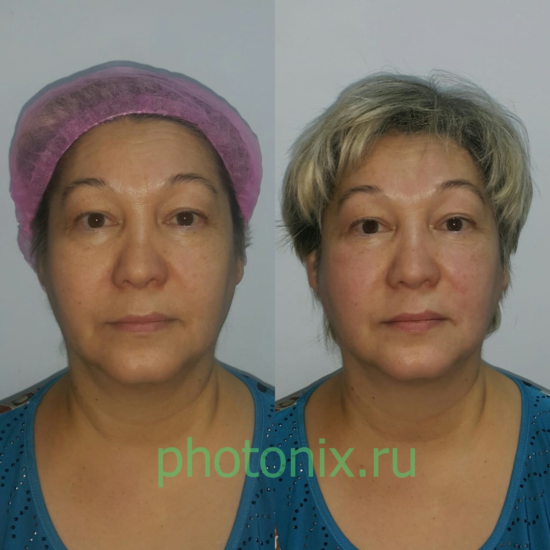 Ультразвуковой аппарат HIFU anti aging FU4.5-9S