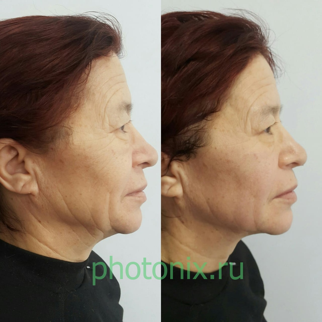 Ультразвуковой аппарат HIFU anti aging FU4.5-9S