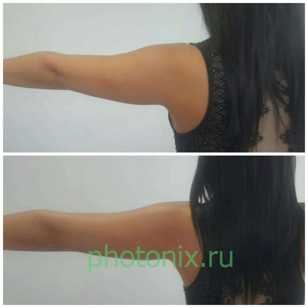 Ультразвуковой аппарат HIFU anti aging FU4.5-9S