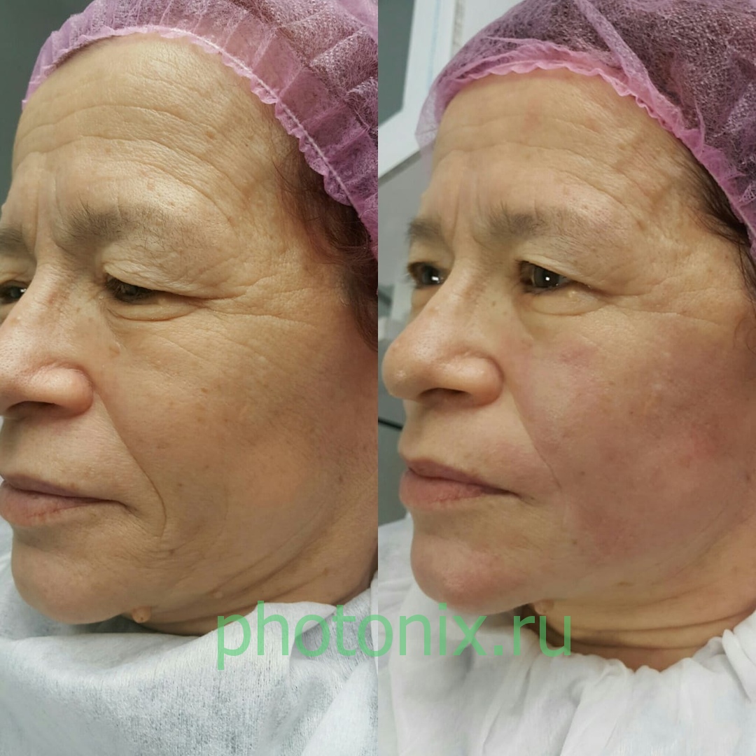 Ультразвуковой аппарат HIFU anti aging FU4.5-9S