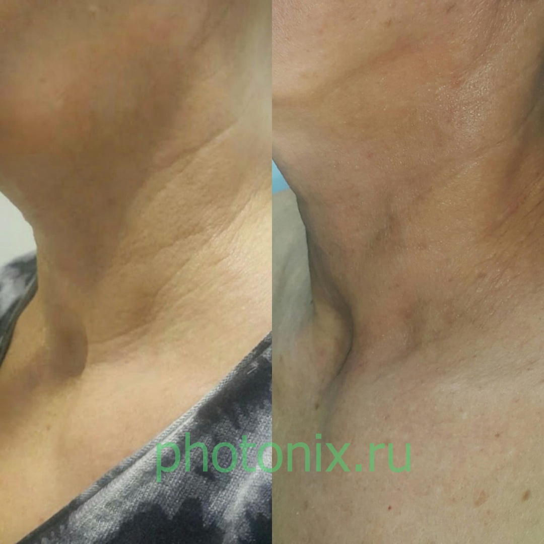 Ультразвуковой аппарат HIFU anti aging FU4.5-9S
