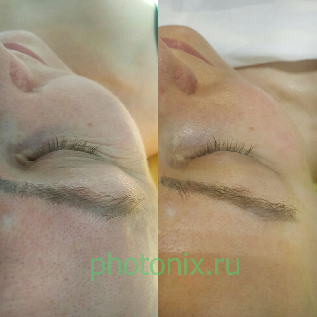 Ультразвуковой аппарат HIFU anti aging FU4.5-9S