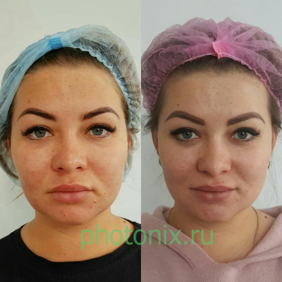 Ультразвуковой аппарат HIFU anti aging FU4.5-9S