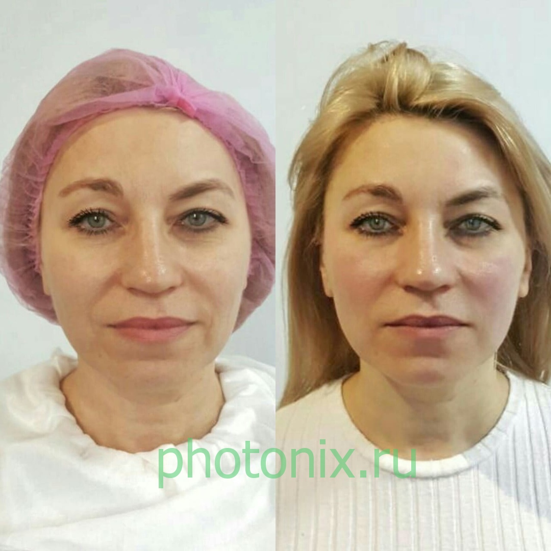 Ультразвуковой аппарат HIFU anti aging FU4.5-9S