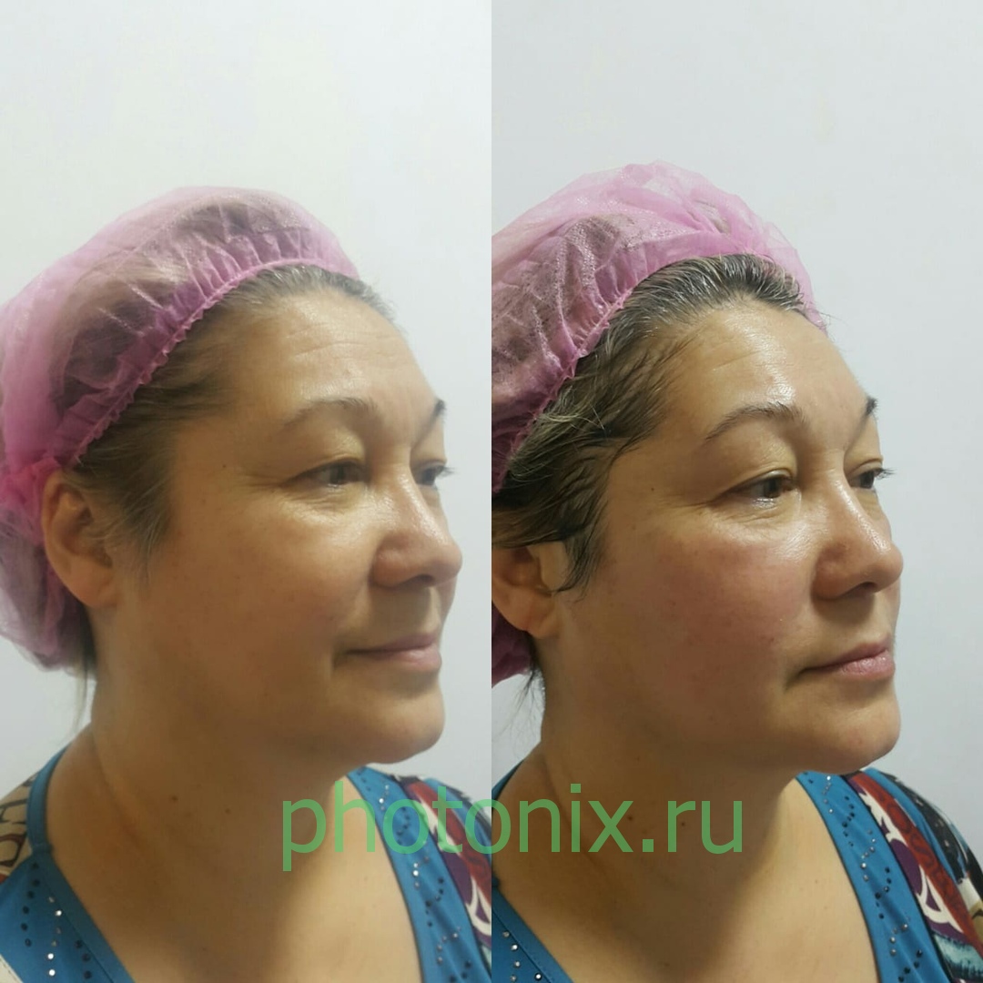 Ультразвуковой аппарат HIFU anti aging FU4.5-9S